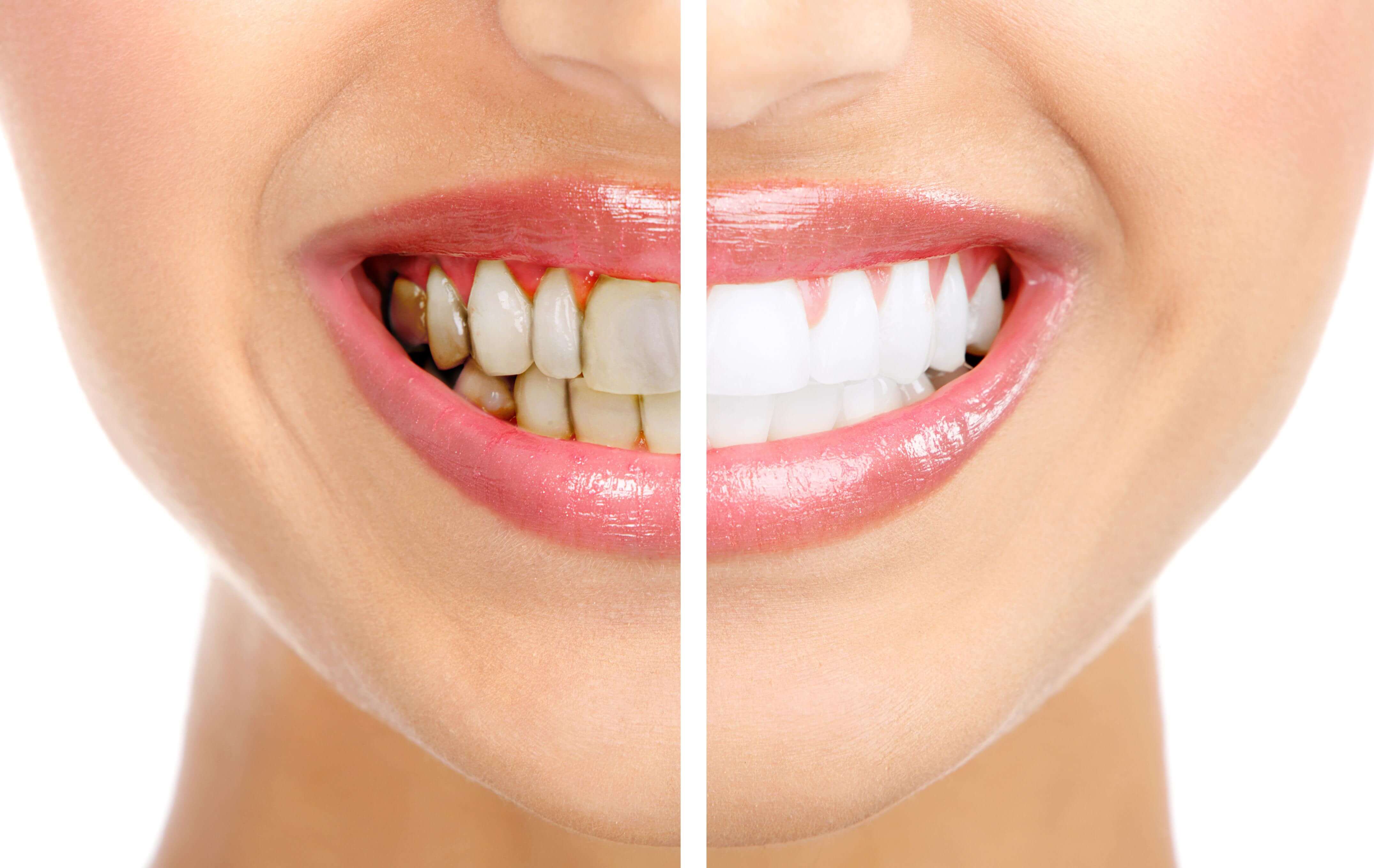 Как правильно очистить зуб от налета дома - советы стоматологов